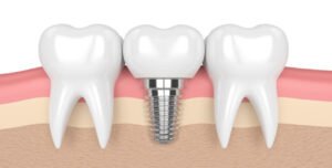 implantology