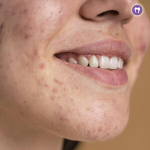 Acne(Pimples) Treatment