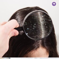 Anti-Dandruff Treatment