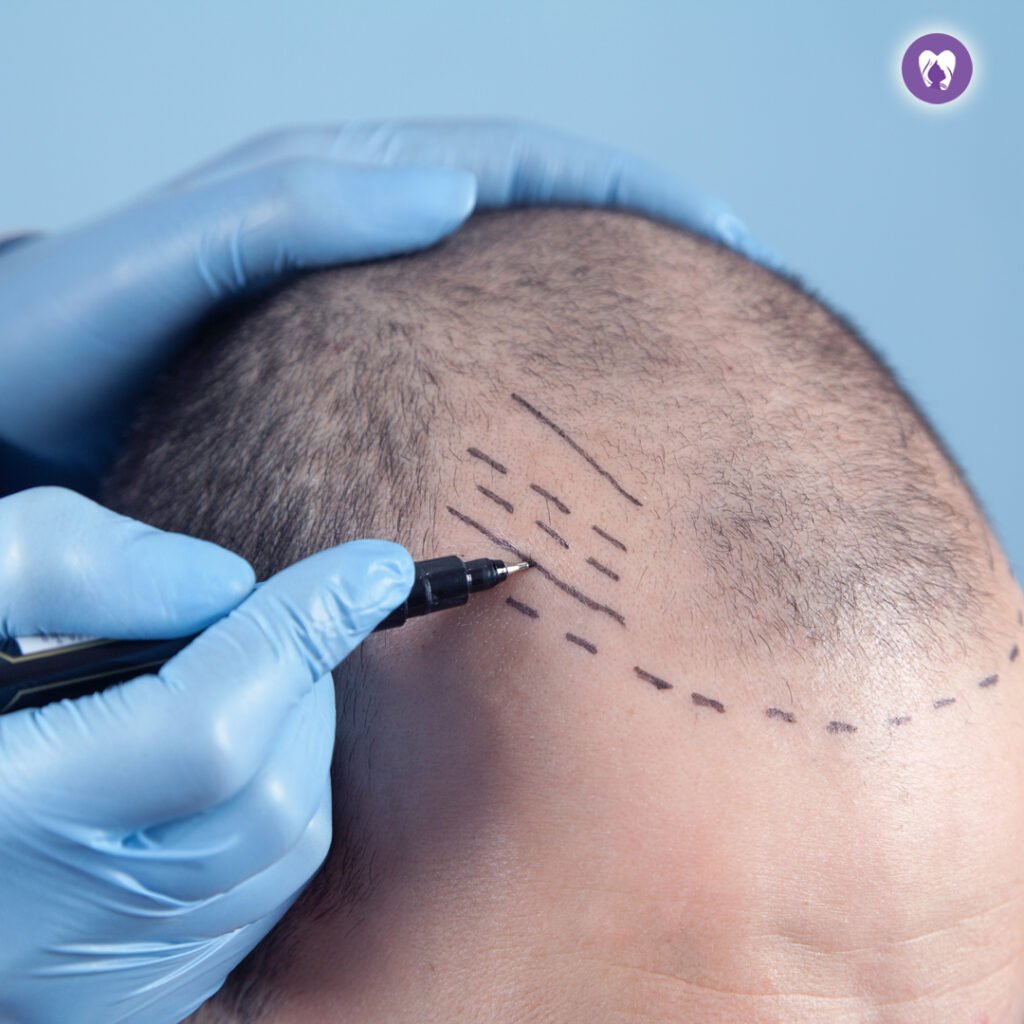 Hair Transplantation