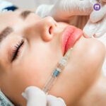 Lip Fillers
