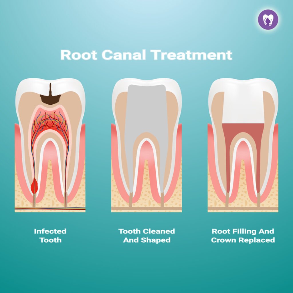 Root Canal Treatment (Endodontics)