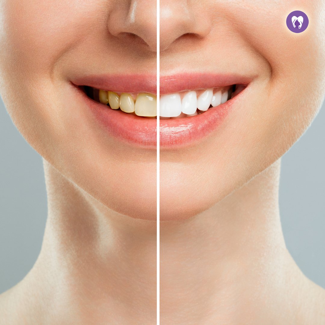 Discover Your Brightest Smile with Teeth Whitening Bleaching