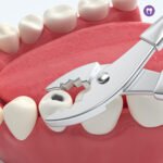 Tooth Removal (Extraction)